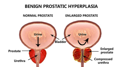 Enlarged Prostate: Is It A Serious Medical Condition?